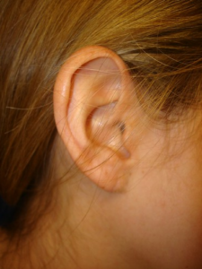 Surgically Repaired Earlobe